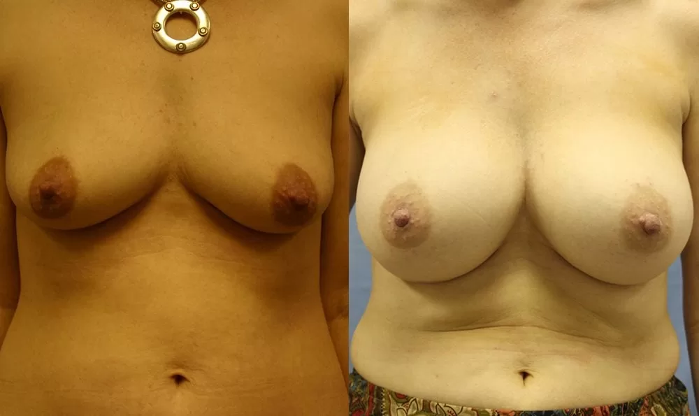Patient 25a breast augmentation before and after
