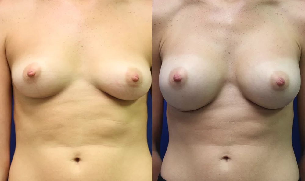 Patient 14a breast augmentation before and after