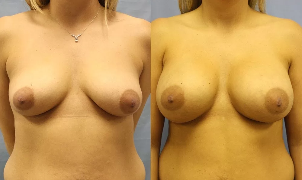 Patient 26a breast augmentation before and after