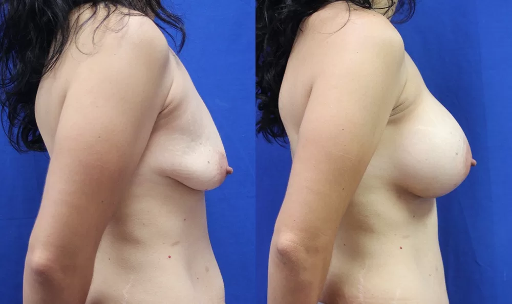 Patient 20c breast augmentation before and after