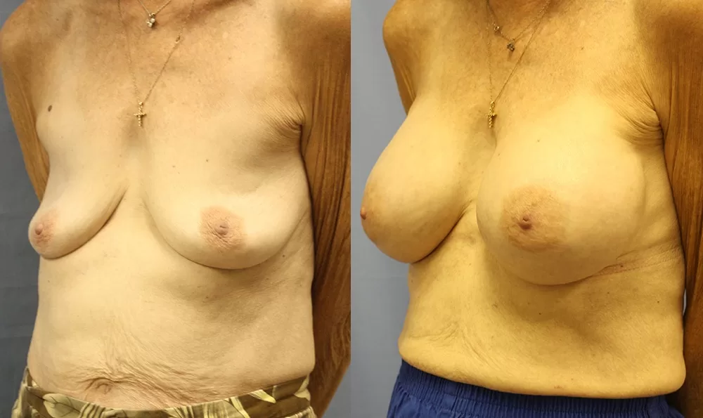 Patient 15b breast augmentation before and after