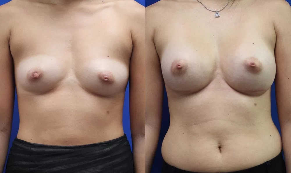Patient 27a breast augmentation before and after
