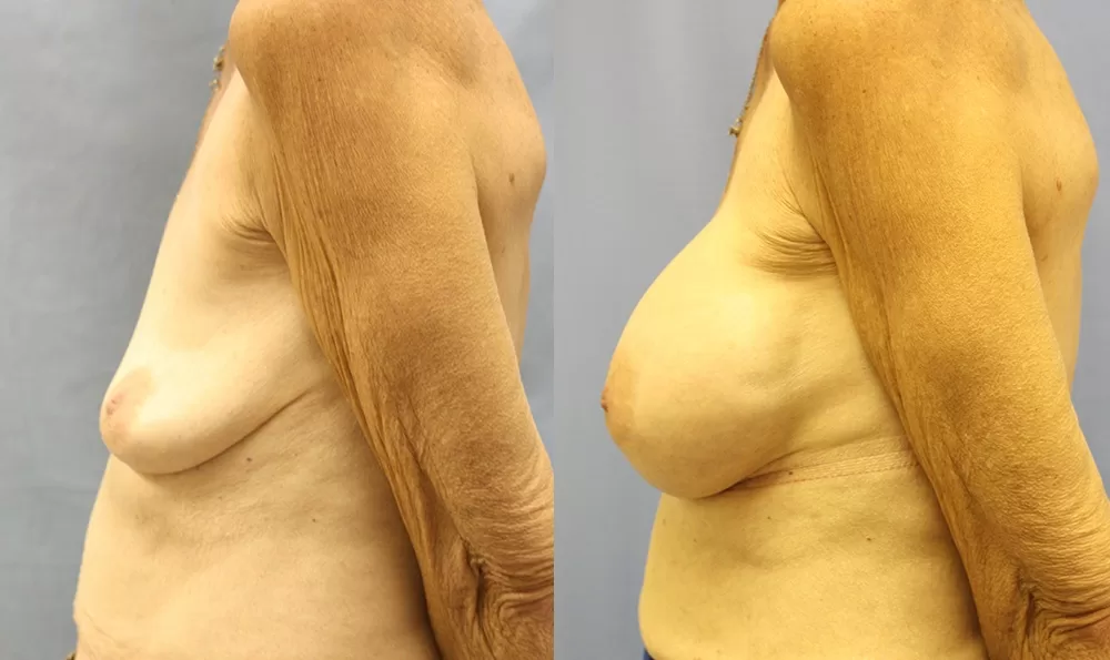 Patient 15c breast augmentation before and after