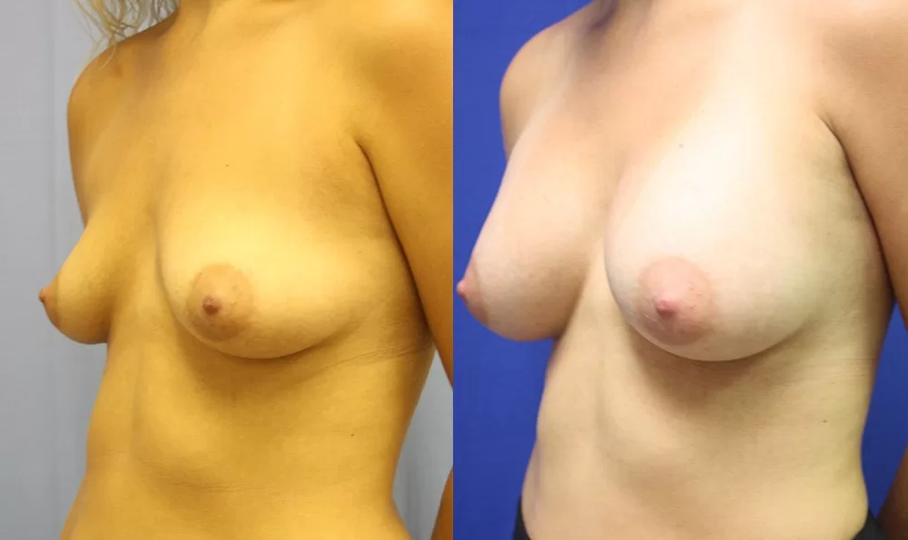 Patient 21b breast augmentation before and after