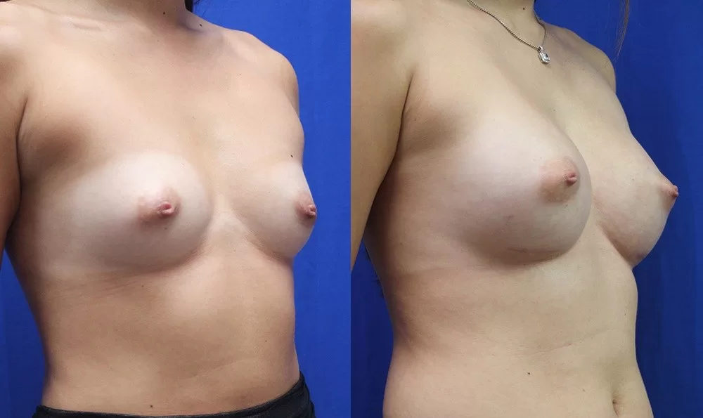 Patient 27b breast augmentation before and after