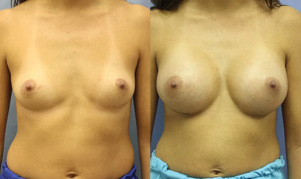 Patient 16a breast augmentation before and after
