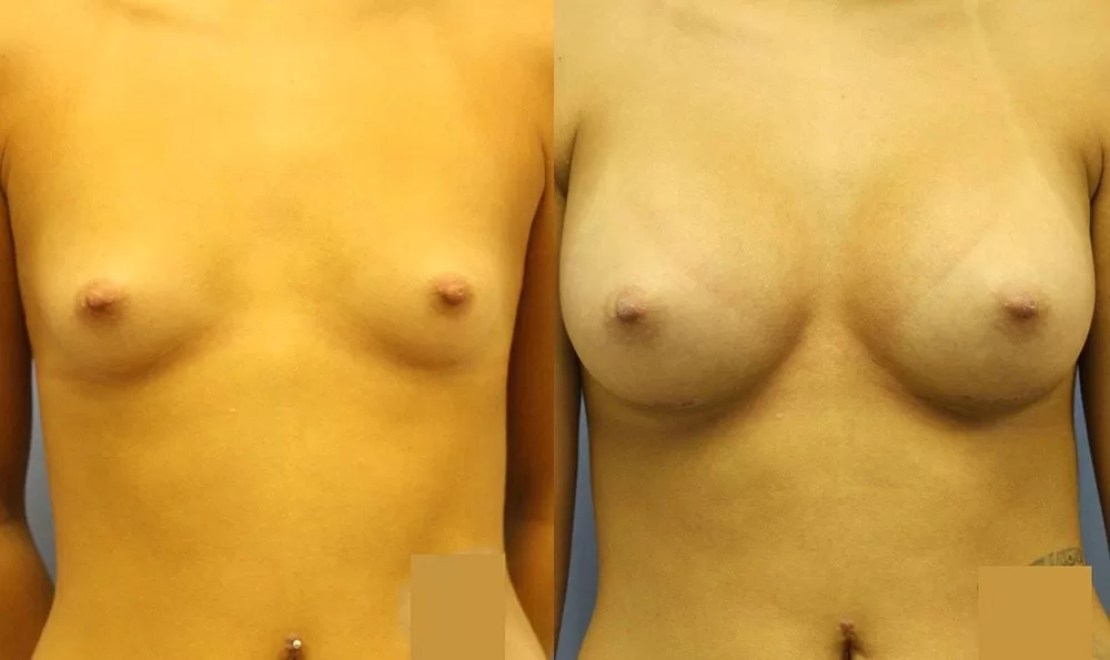 Patient 28a breast augmentation before and after