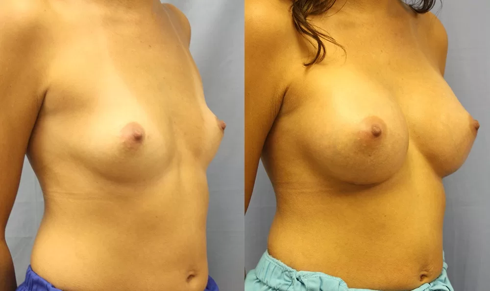 Patient 16c breast augmentation before and after