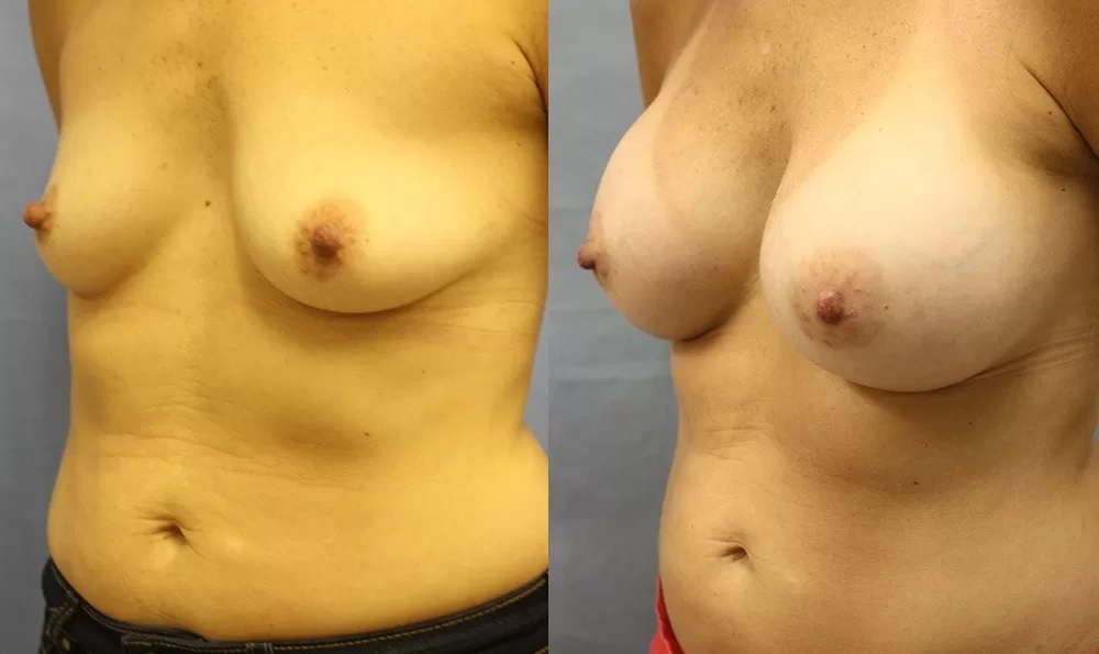 Patient 22b breast augmentation before and after