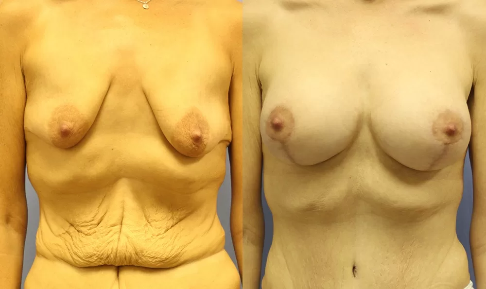 Patient 12a breast augmentation before and after