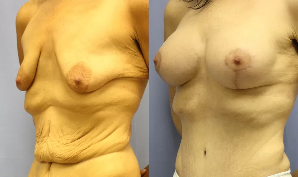 Patient 12b breast augmentation before and after