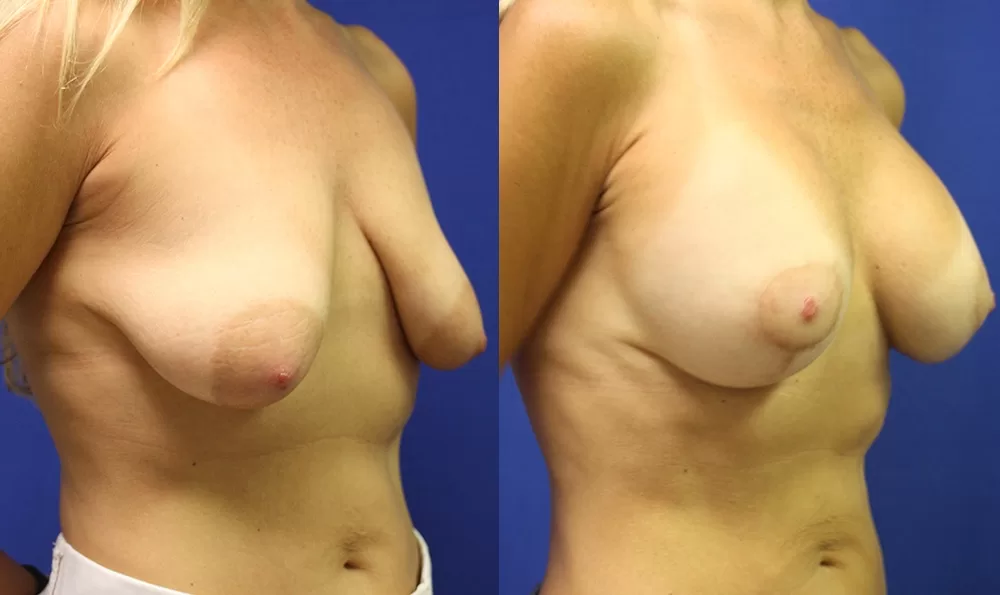 Patient 17b breast augmentation before and after