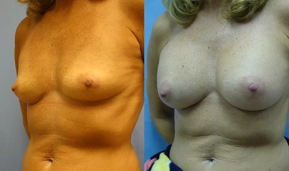 Patient 23b breast augmentation before and after