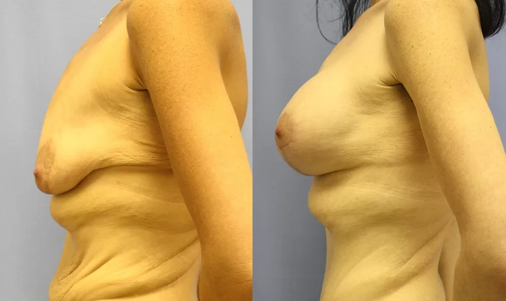 Patient 12c breast augmentation before and after