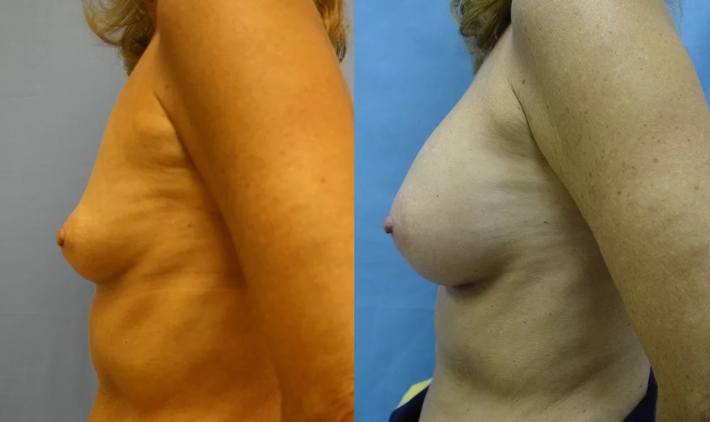 Patient 23c breast augmentation before and after