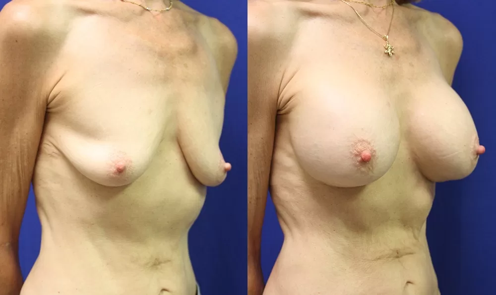 Patient 18b breast augmentation before and after