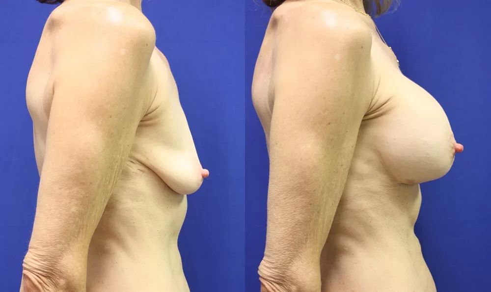 Patient 18c breast augmentation before and after
