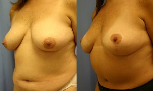 Patient 6b Breast Lift Before and After