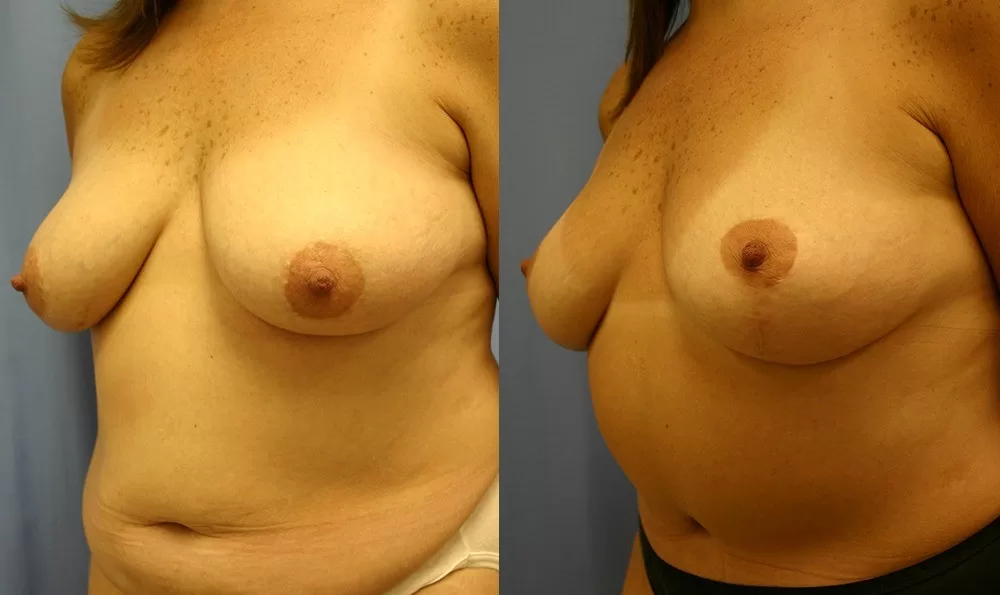 Patient 6b breast lift before and after