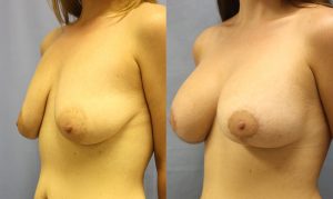 Patient 30b Breast Augmentation Before and After