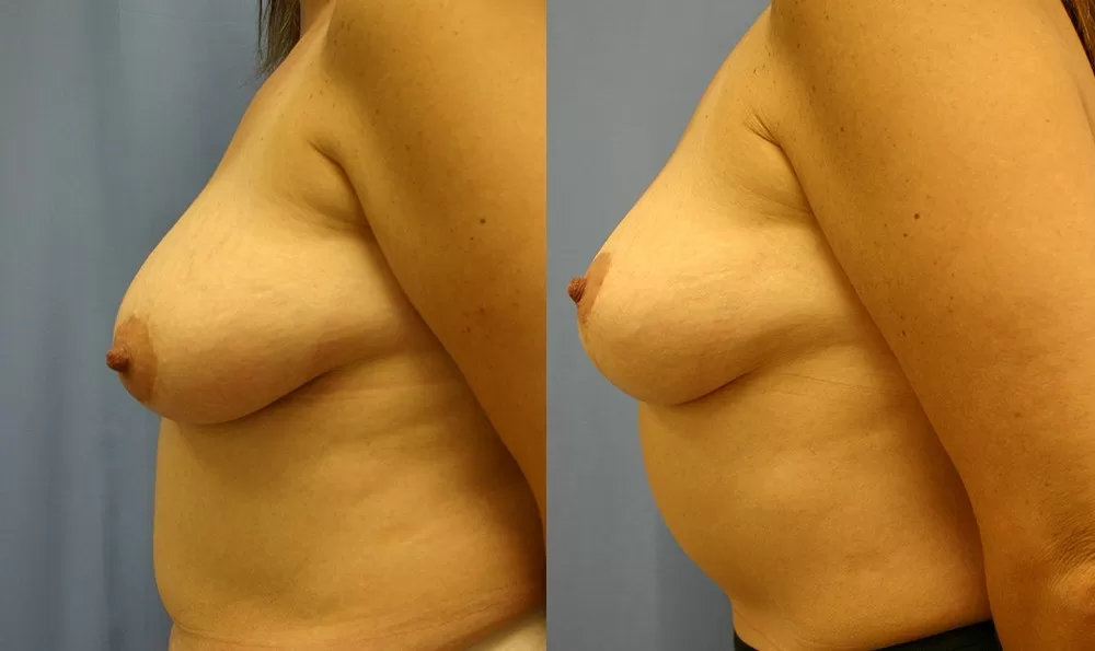 Patient 6c breast lift before and after