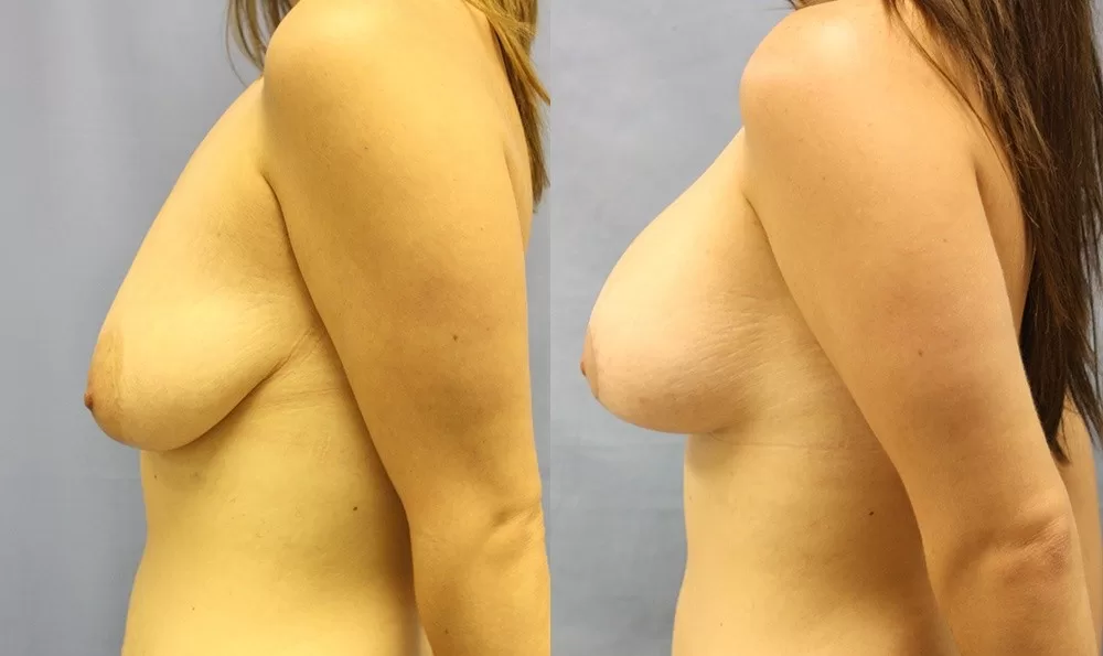 Patient 30c breast augmentation before and after