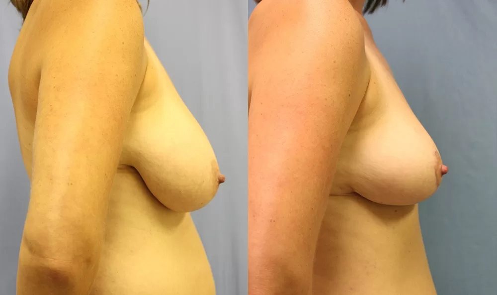 Patient 2b breast reduction before and after