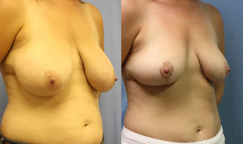 Patient 2c breast reduction before and after
