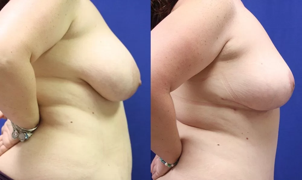 Patient 32a breast augmentation before and after