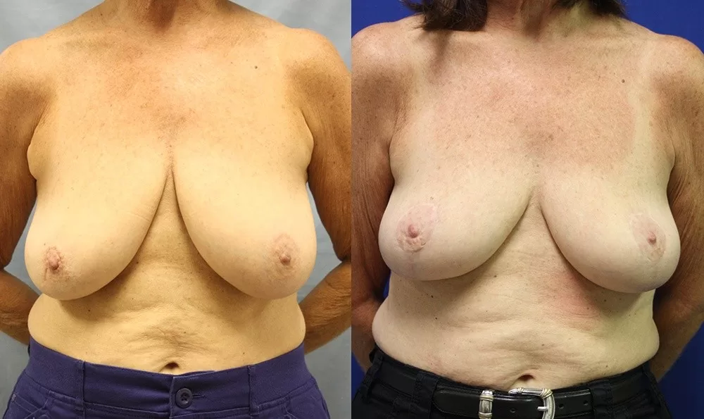 Patient 10a breast lift before and after