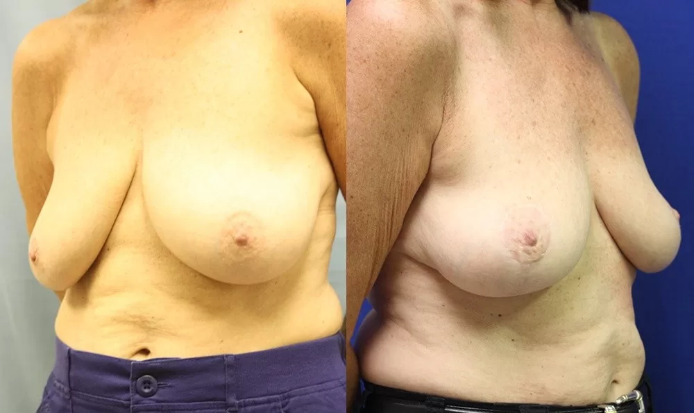 Patient 10b breast lift before and after