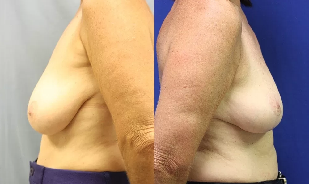 Patient 10c breast lift before and after