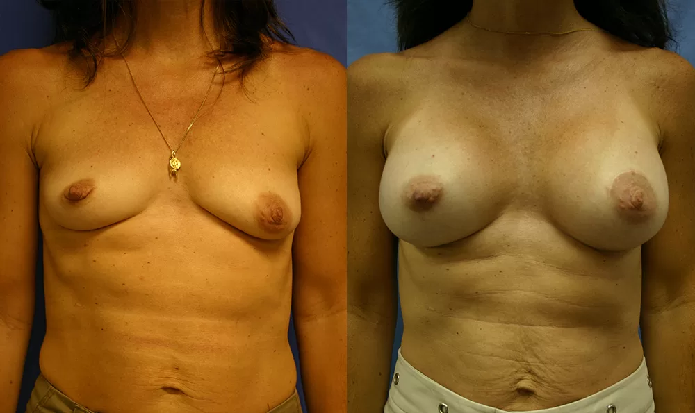 Patient 10a breast augmentation before and after