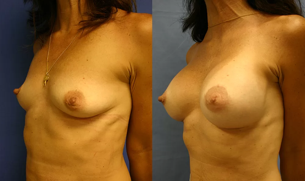 Patient 10b breast augmentation before and after