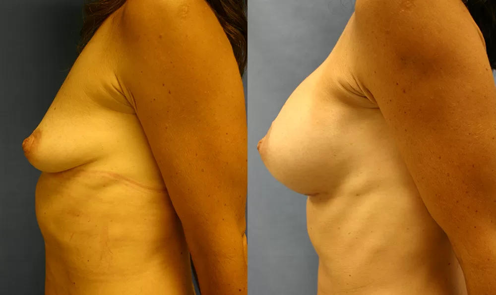 Patient 10c breast augmentation before and after