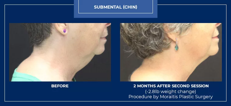 Moraitis palm harbor coolsculpting patient 1 1 2