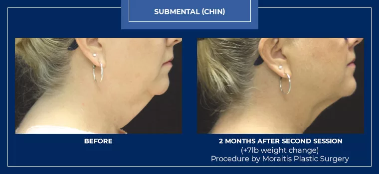 Moraitis palm harbor coolsculpting patient 2 1 2