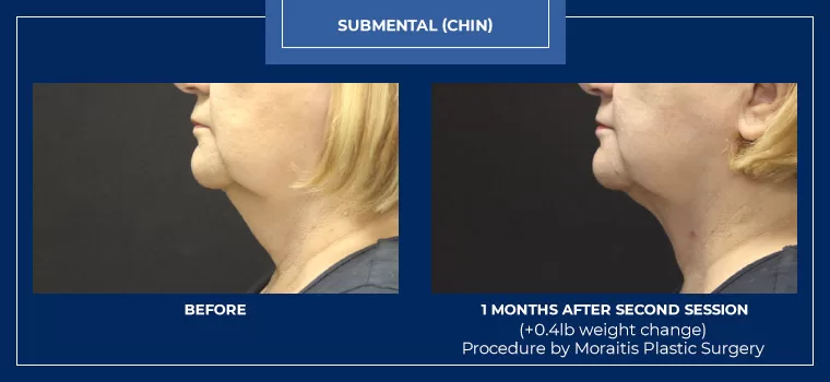Moraitis palm harbor coolsculpting patient 3 1 2