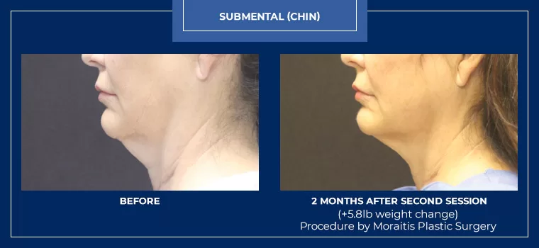 Moraitis palm harbor coolsculpting patient 4 1 2