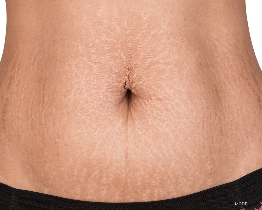 Close up of a belly with stretch marks | moraitis plastic surgery Close up of a belly with stretch marks