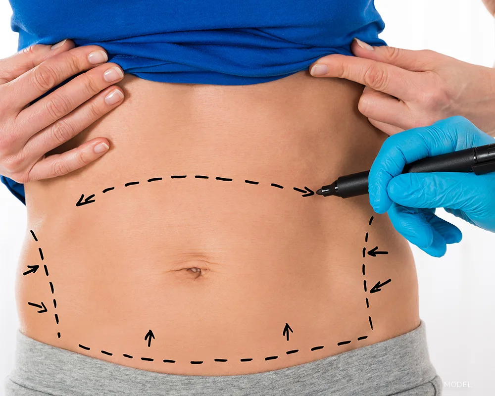 Female belly with marks showing fat removal areas