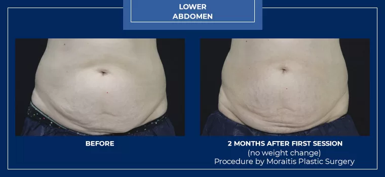 Moraitis palm harbor coolsculpting patient 10 1