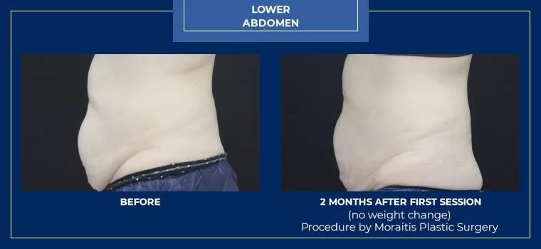 Moraitis palm harbor coolsculpting patient 10 2