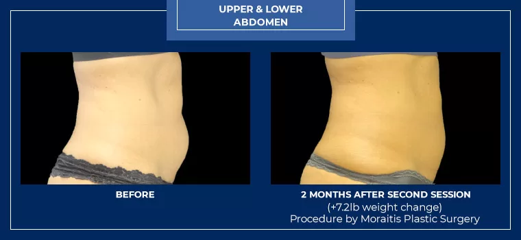 Moraitis palm harbor coolsculpting patient 11 1