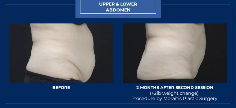 Moraitis palm harbor coolsculpting patient 12 1