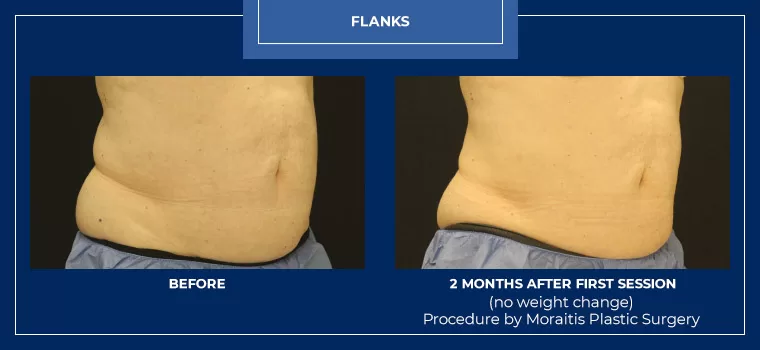 Moraitis palm harbor coolsculpting patient 13 1