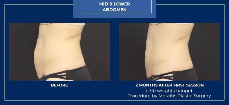 Moraitis palm harbor coolsculpting patient 14 1