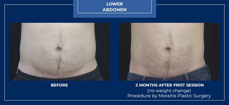 Moraitis palm harbor coolsculpting patient 15 1