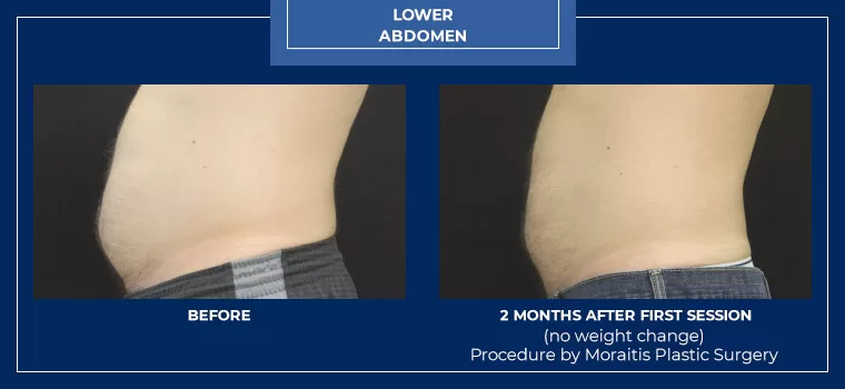 Moraitis palm harbor coolsculpting patient 15 2