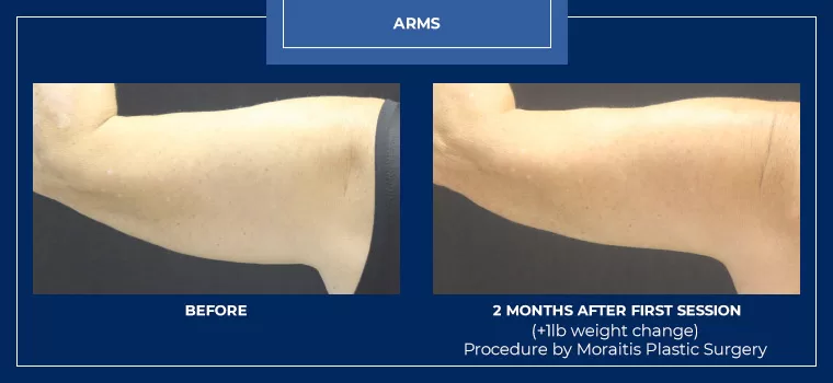 Moraitis palm harbor coolsculpting patient 16 1